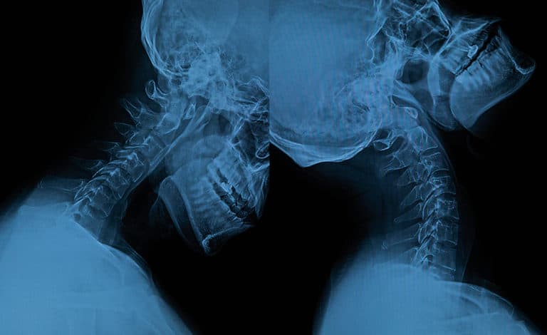 x ray of whiplash and neck injury from an auto accident neck injuries