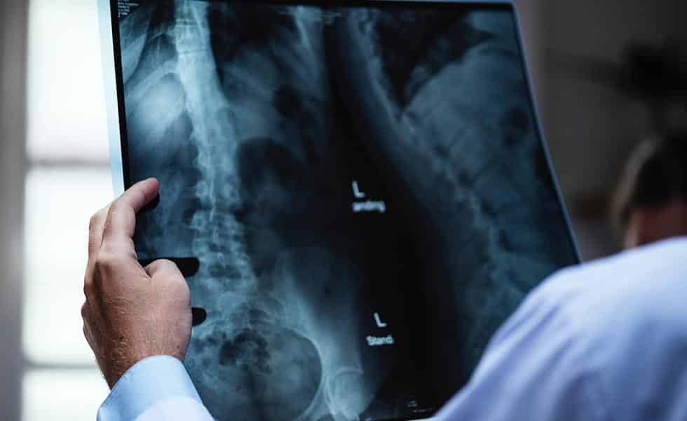 doctor looks at an x ray of leg and back injuries from a rear-end collision settlement